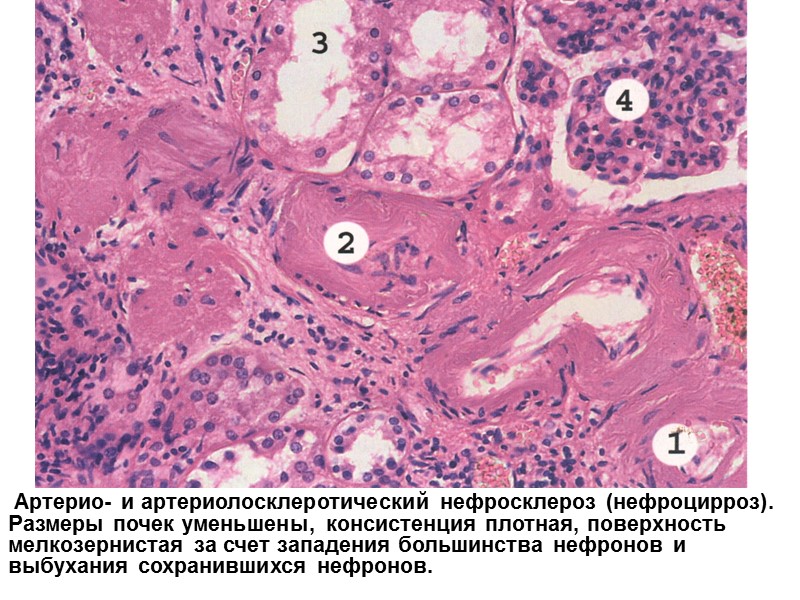 Артерио- и артериолосклеротический нефросклероз (нефроцирроз). Размеры почек уменьшены, консистенция плотная, поверхность мелкозернистая за счет